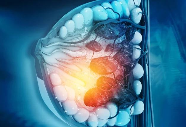 Imagen generada por ordenador de un cáncer de mama.